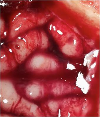 Navigated, Robot-Driven Laser Craniotomy for SEEG Application Using Optical Coherence Tomography in an Animal Model